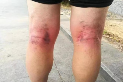 痧是什么?结节是什么?癌是什么?