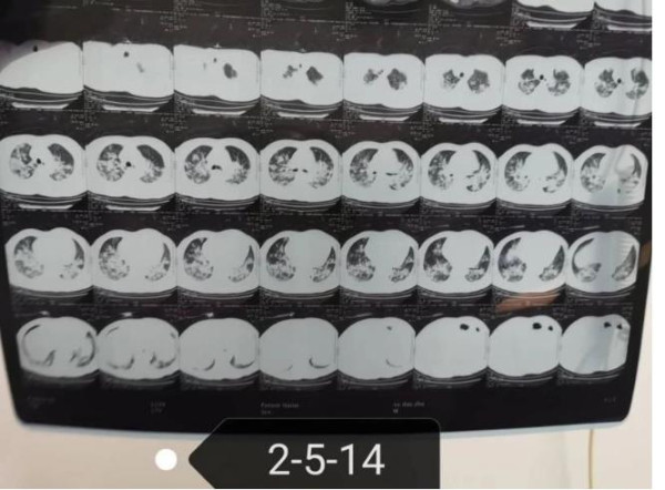 中医究竟效果如何？且看一位青年女中医抗击新冠肺炎纪实