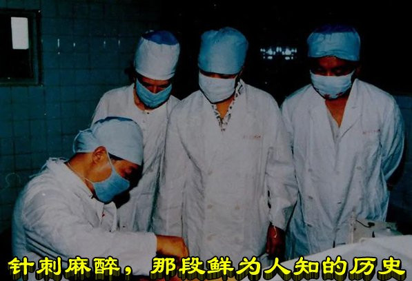 针刺麻醉，那段鲜为人知的历史