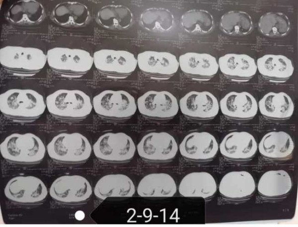 中医究竟效果如何？且看一位青年女中医抗击新冠肺炎纪实