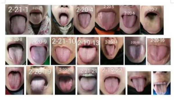 中医究竟效果如何？且看一位青年女中医抗击新冠肺炎纪实