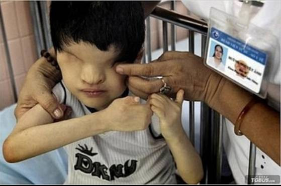 美军遗毒:“橙剂”阴影下的越南儿童