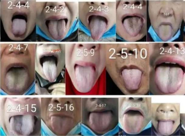 中医究竟效果如何？且看一位青年女中医抗击新冠肺炎纪实